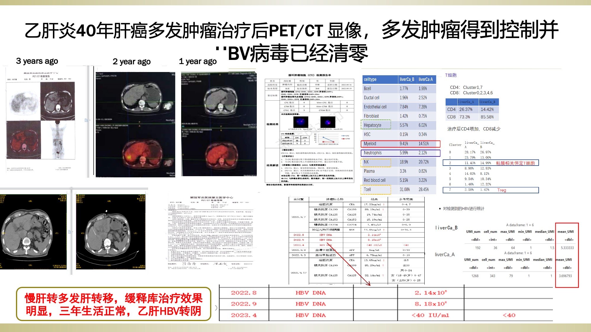 Large liver cancer PET/CT before and after treatment