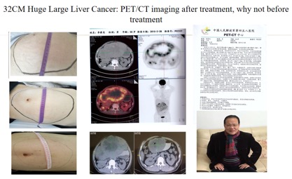 Chemical Conization for Cervical Precancerous Lesions