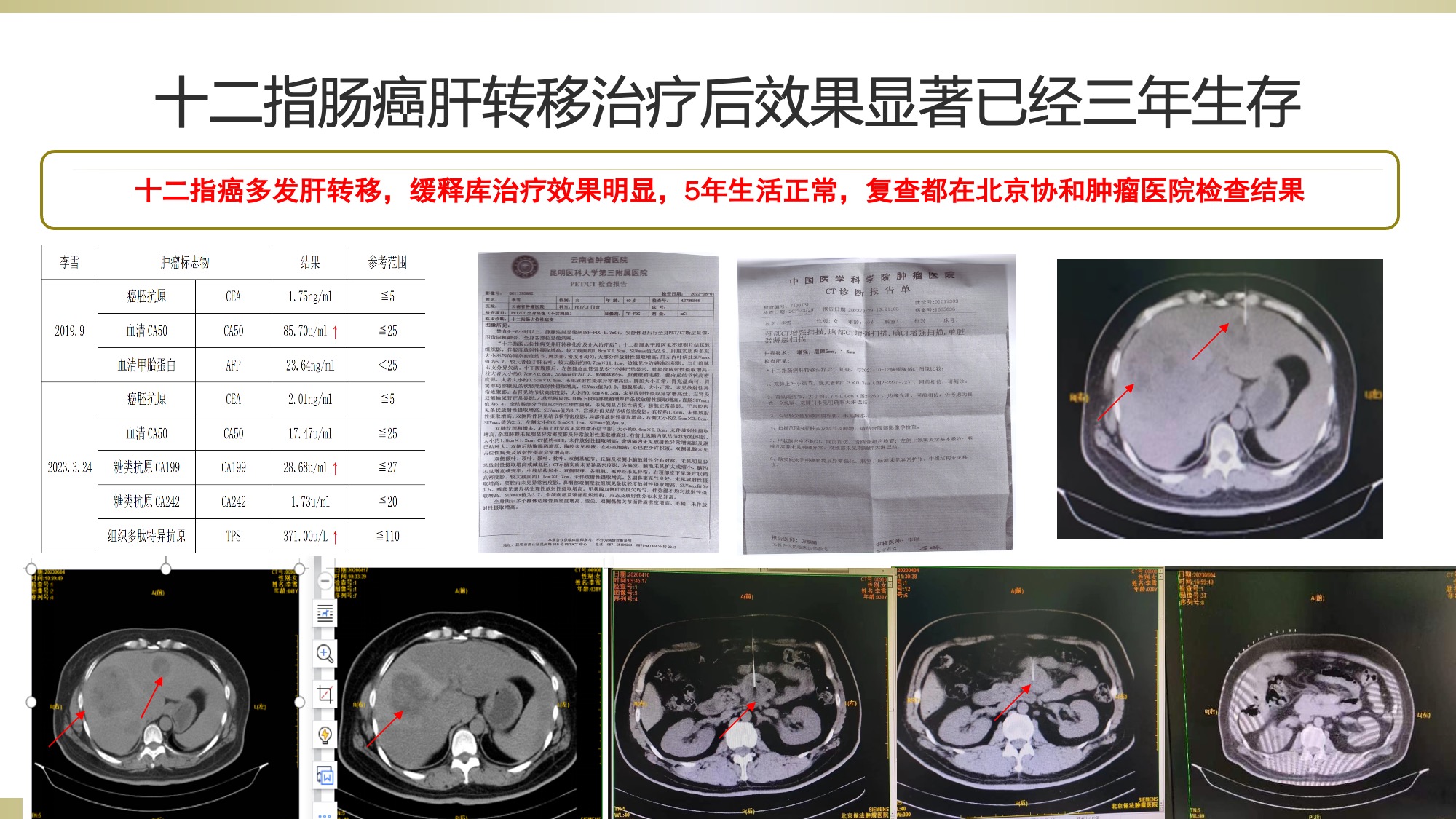 Chronic Hepatitis B & HBV Negative Conversion